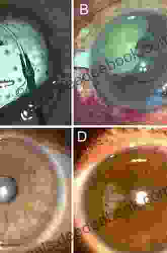 Complications During And After Cataract Surgery: From Phacoemulsification Over Secondary IOL Implantation To Dropped Nucleus